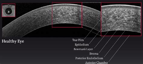 oct measurement for corneal thickness|anterior segment oct scan.